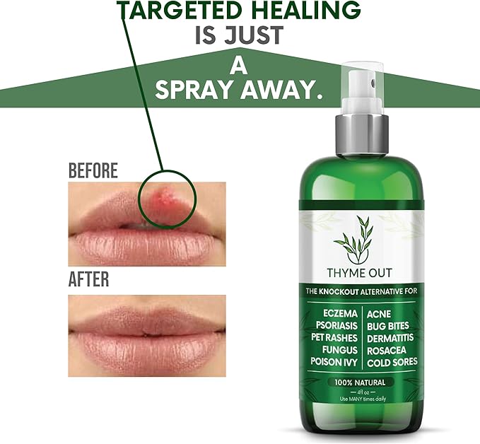 Thyme Out All Natural Eczema Treatment- Psoriasis Treatment - an All-in-One Solution for Acne, Dermatitis, Rosacea, Cold Sores, Bites, Poison Ivy - Anti-Itch Spray for Itchy Skin Relief 4oz